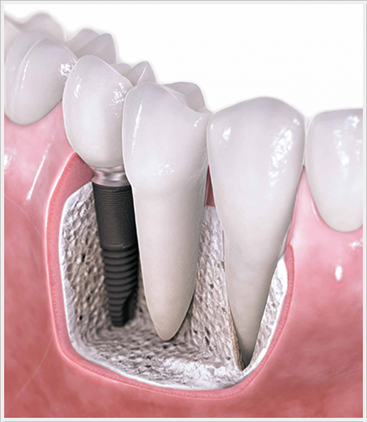Cerrahi İmplant Tedavisi Dt. Ömer Bayar Diş Estetiği Gülüş Tasarımı