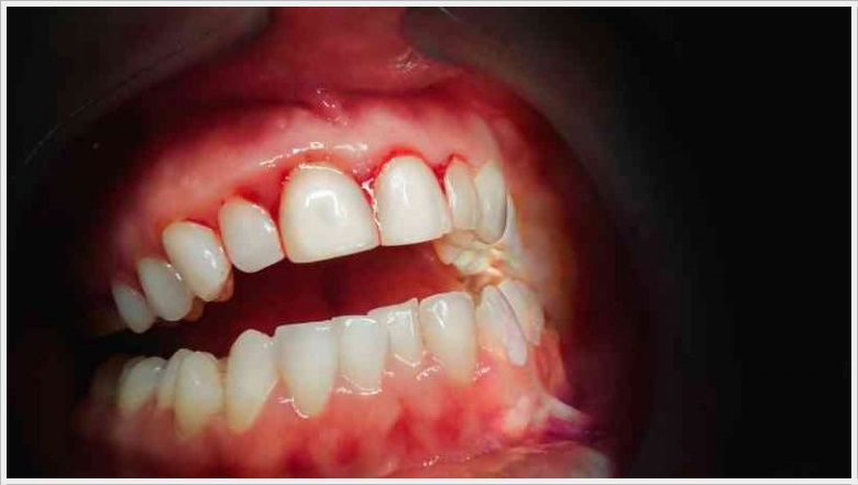 Dis Eti Kanaması ve Tedavisi Dt. Ömer Bayar Diş Estetiği Gülüş