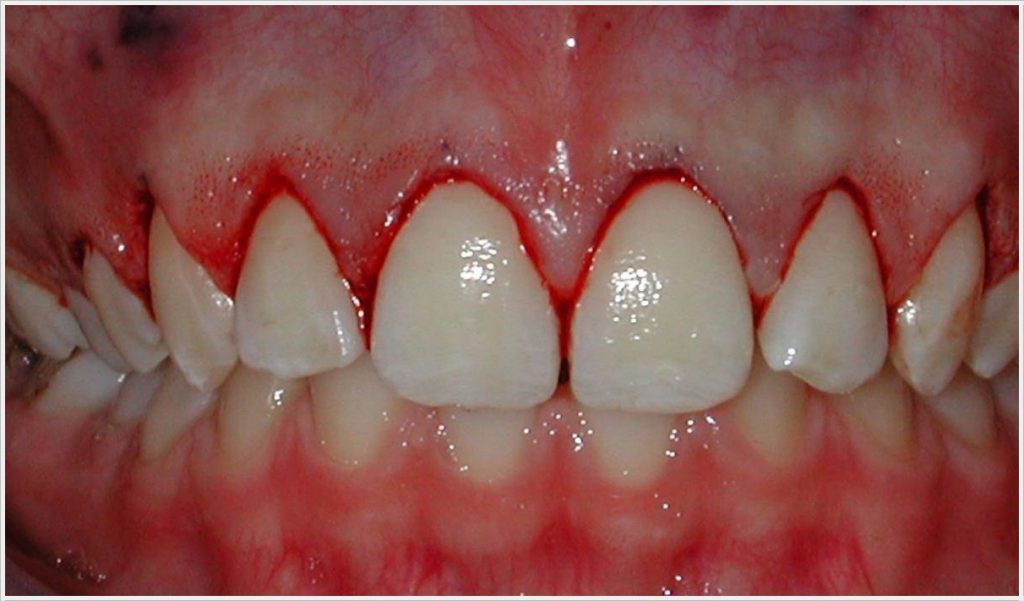 Dis Eti Kanaması ve Tedavisi Dt. Ömer Bayar Diş Estetiği Gülüş