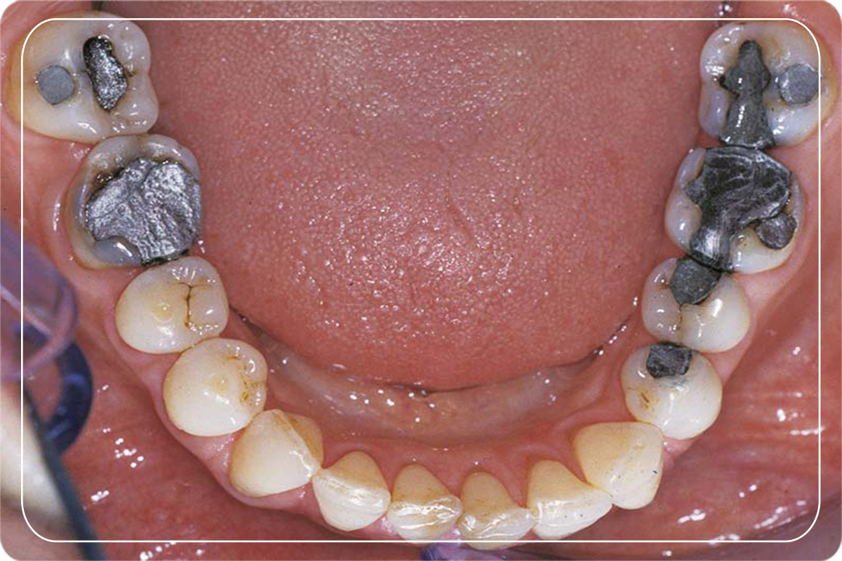Amalgam Dolgu Diş Estetiği Gülüş Tasarımı Dr. Dt. Ömer Bayar