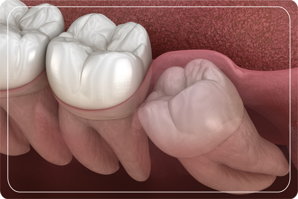 Gömülü Dişlerin Hepsi Çekilmeli Mi? Diş Estetiği Gülüş Tasarımı