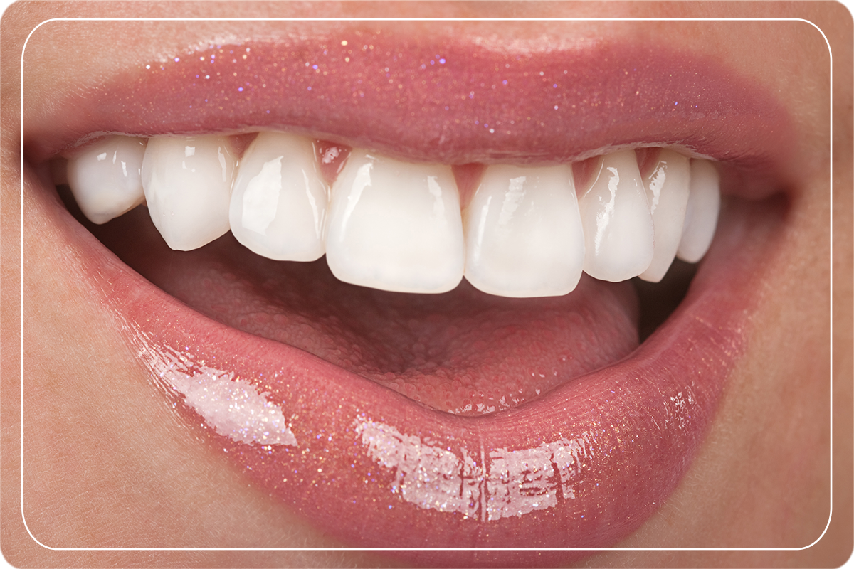 Lamine Diş Yaptıranların Yorumları Diş Estetiği Gülüş Tasarımı Dr